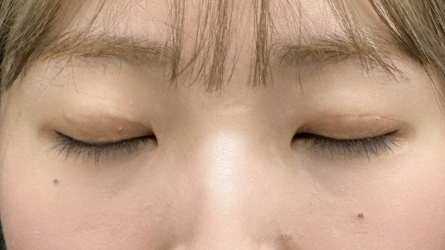 Postoperative Condition Part 1