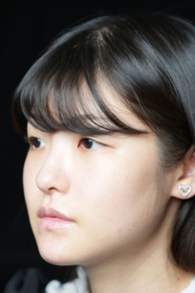 手術後の状態 その1