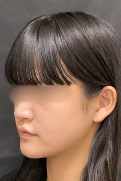 手術後の状態 その1