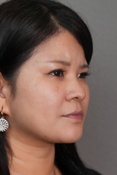 手術後の状態 その1