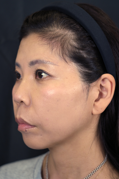 手術後の状態 その1