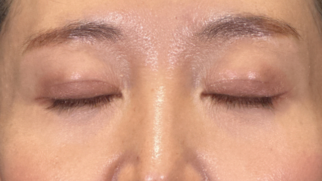 Postoperative Condition Part 1