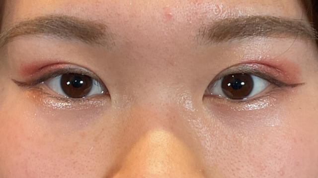 Postoperative Condition Part 1