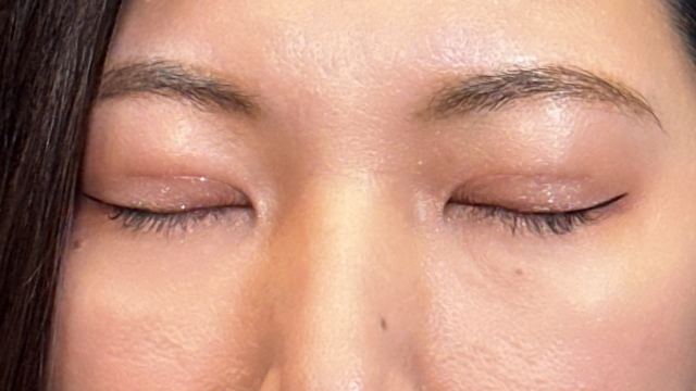 Postoperative Condition Part 1