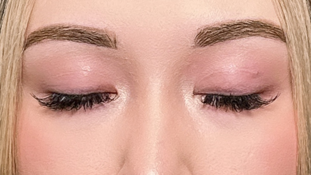 Postoperative Condition Part 1