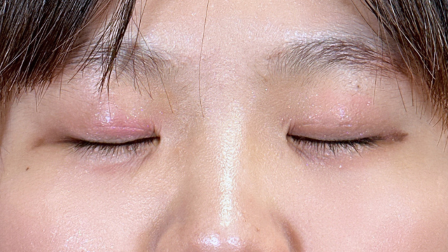 Postoperative Condition Part 1