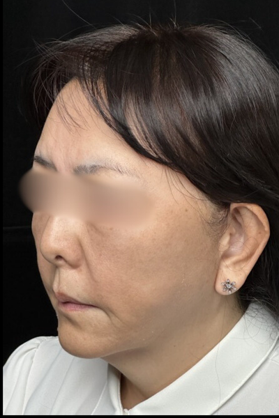 手術後の状態 その1