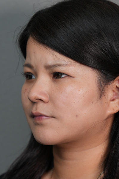 手術後の状態 その1