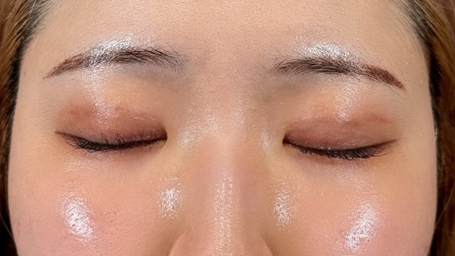 Postoperative Condition Part 1