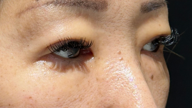 手术后的状态 其一