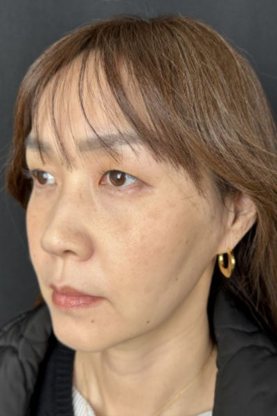 手術後の状態 その1