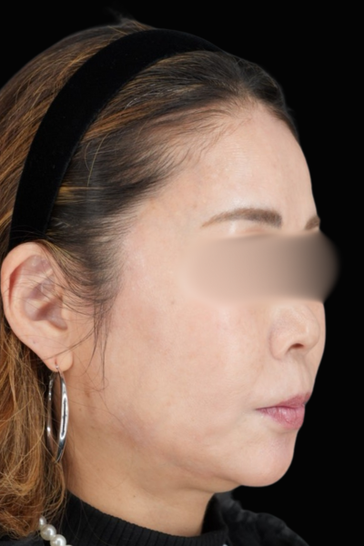 手術後の状態 その1