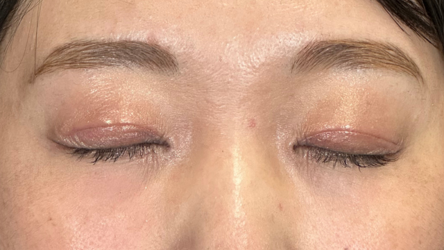 手術後の状態 その1