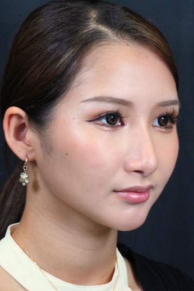 手術後の状態 その1