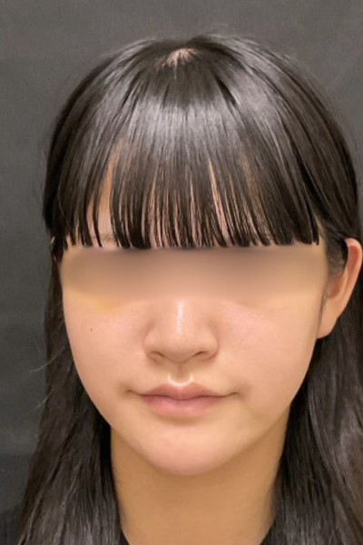 手術後の状態 その1