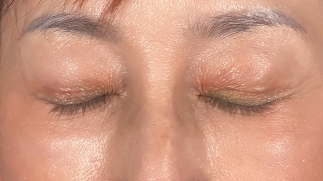 Postoperative Condition Part 1