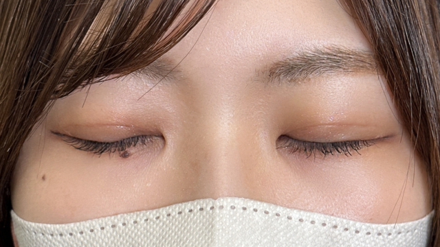 Postoperative Condition Part 1