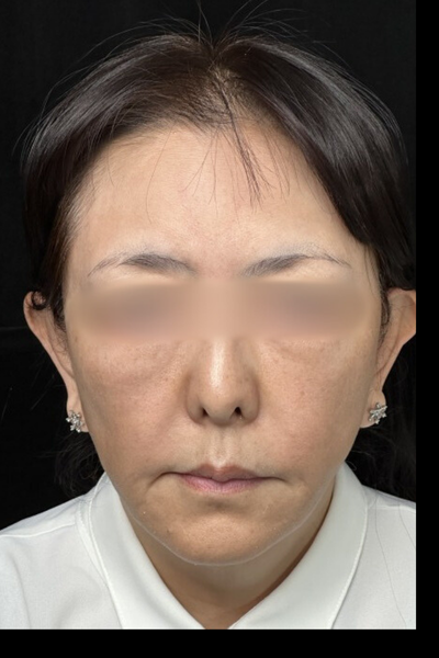 手術後の状態 その1