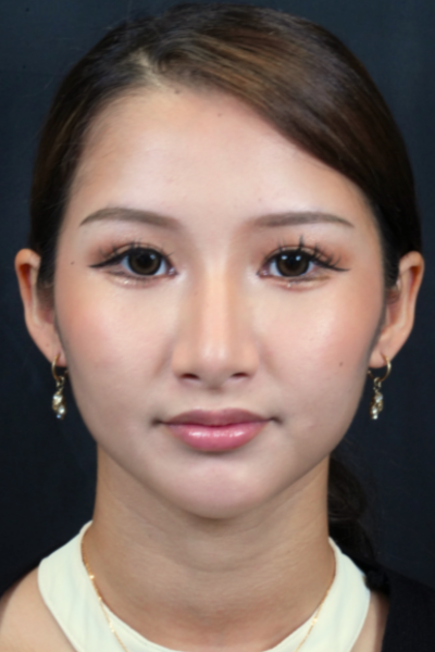 手術後の状態 その1