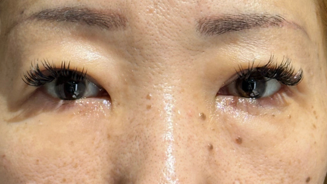 手术后的状态 其一