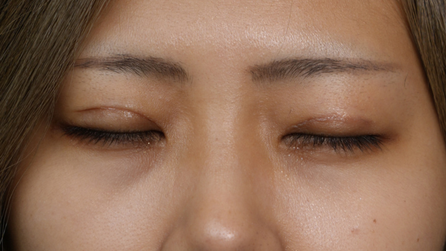 Postoperative Condition Part 1