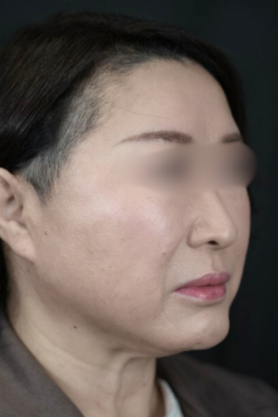 手術後の状態 その1