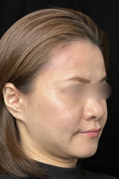 手術後の状態 その1