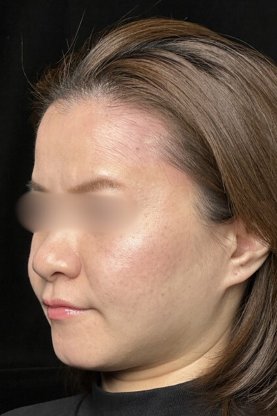 手術後の状態 その1