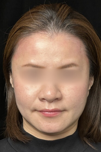 手術後の状態 その1