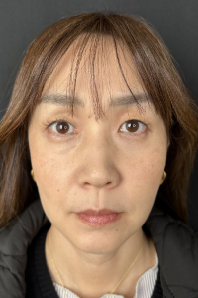 手術後の状態 その1