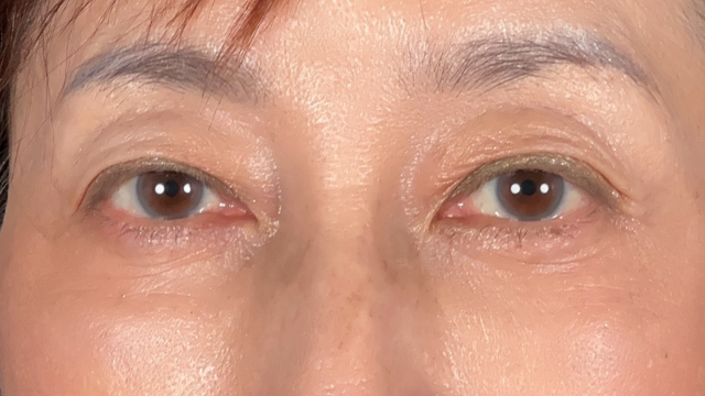 Postoperative Condition Part 1