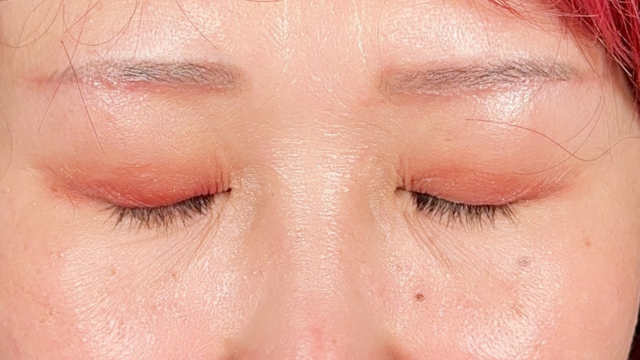 Postoperative Condition Part 1