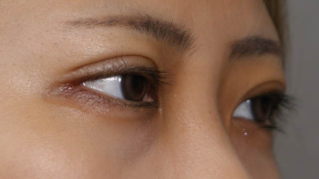 Postoperative Condition Part 1