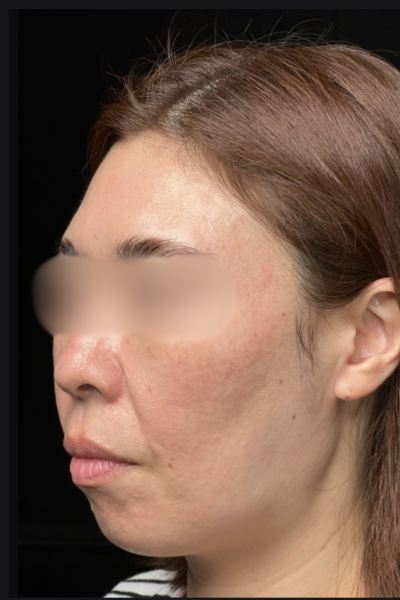 手術後の状態 その1