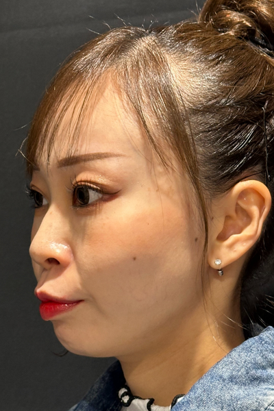 手術後の状態 その1