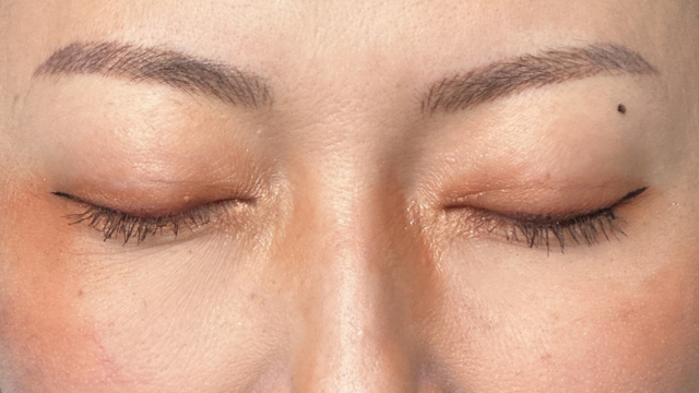 Postoperative Condition Part 1