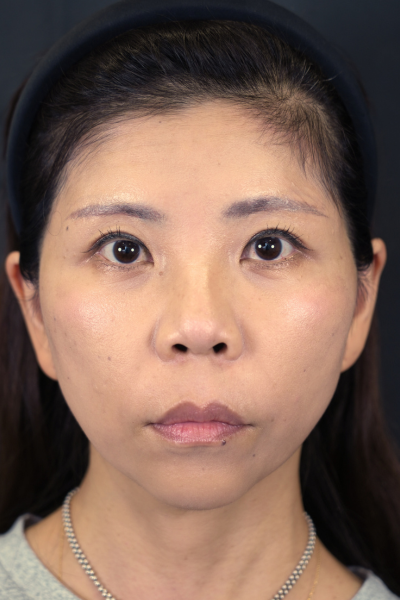 手術後の状態 その1