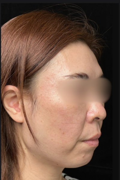 手術後の状態 その1