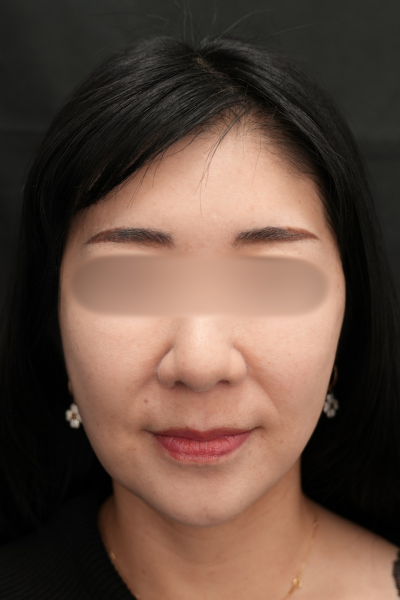 手術後の状態 その1