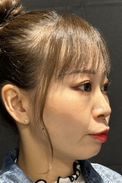 手術後の状態 その1