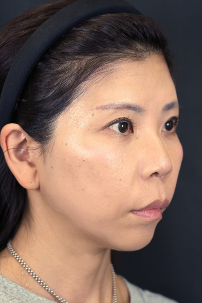 手術後の状態 その1