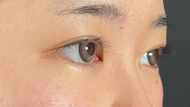 Postoperative Condition Part 1