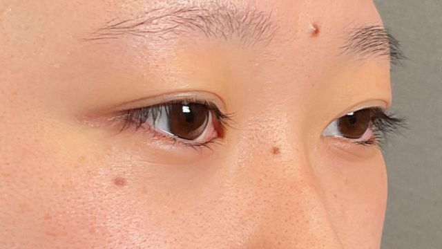 Postoperative Condition Part 1