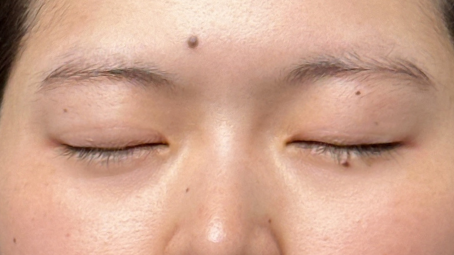 Postoperative Condition Part 1