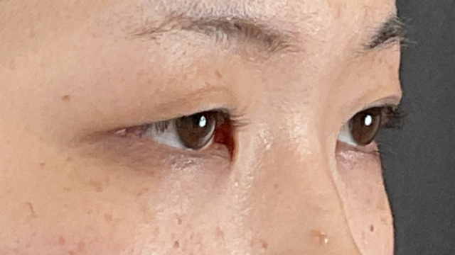 Postoperative Condition Part 1