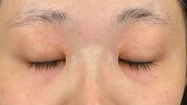 Postoperative Condition Part 1