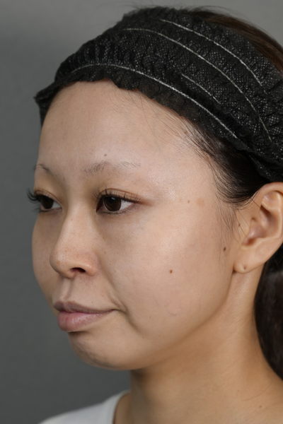 手術前の状態 その1