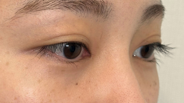 Postoperative Condition Part 1