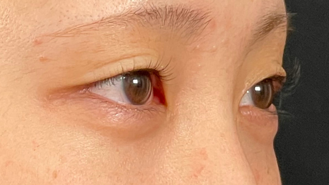 Postoperative Condition Part 1