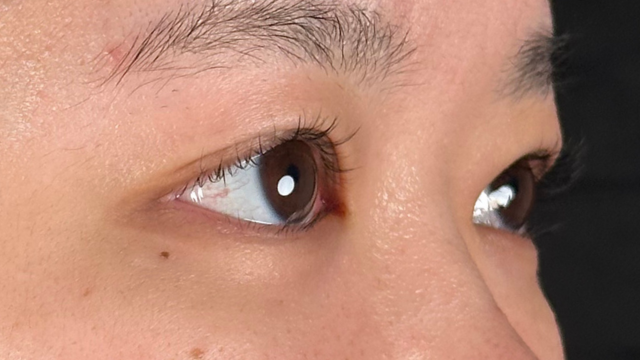 Postoperative Condition Part 1